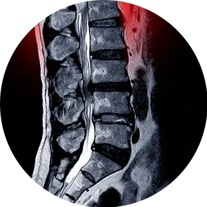 Spinal Stenosis Treatment Near Me in Jackson Township, NJ. Chiropractor For Spinal Stenosis Pain Relief.